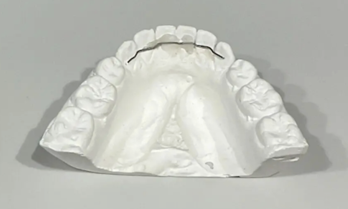 歯列模型のフィックスリテーナー（固定式ワイヤー保定装置）の写真｜奈良の矯正歯科
