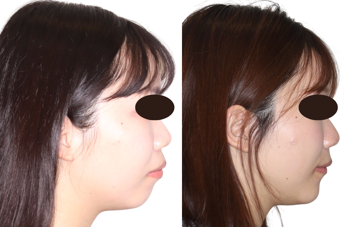 抜歯矯正の術前術後｜口元改善｜奈良の矯正歯科 氏井矯正歯科クリニック