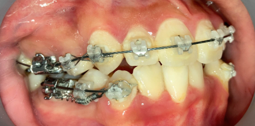抜歯矯正6ヶ月後の経過写真｜隙間閉鎖間近｜奈良の矯正歯科
