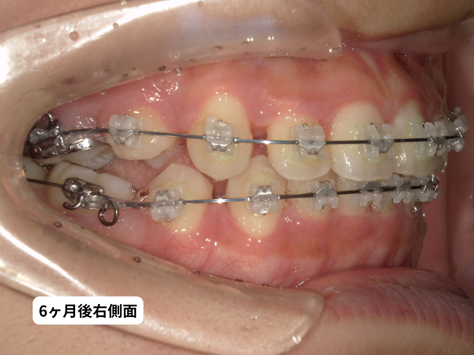 先天性欠如歯 矯正治療 6ヶ月後 右側面｜奈良の矯正歯科 氏井矯正歯科クリニック