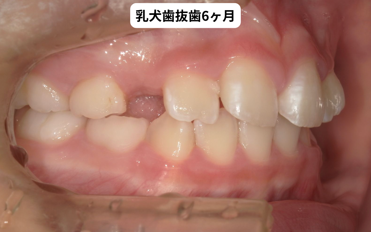 乳犬歯抜歯6ヶ月後の経過写真｜犬歯はまだ萌出していない｜奈良の矯正歯科 氏井矯正歯科クリニック