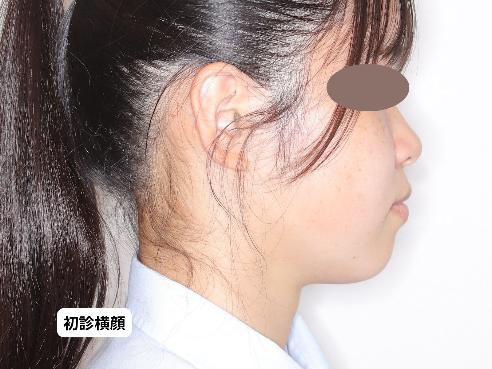 初診時の横顔｜奈良の矯正歯科 氏井矯正歯科クリニック