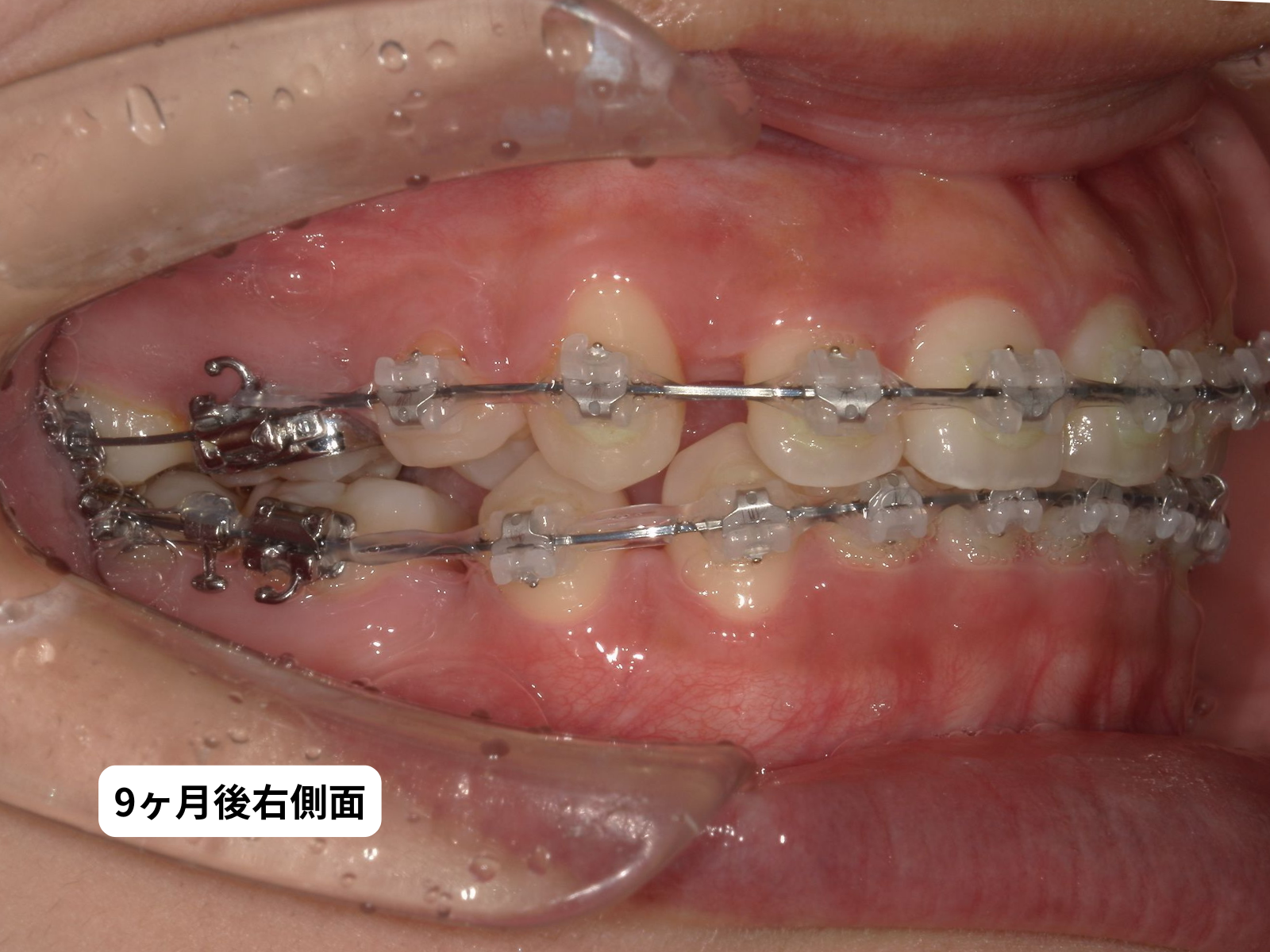 先天性欠如歯 矯正治療 9ヶ月後 右側面｜奈良の矯正歯科 氏井矯正歯科クリニック