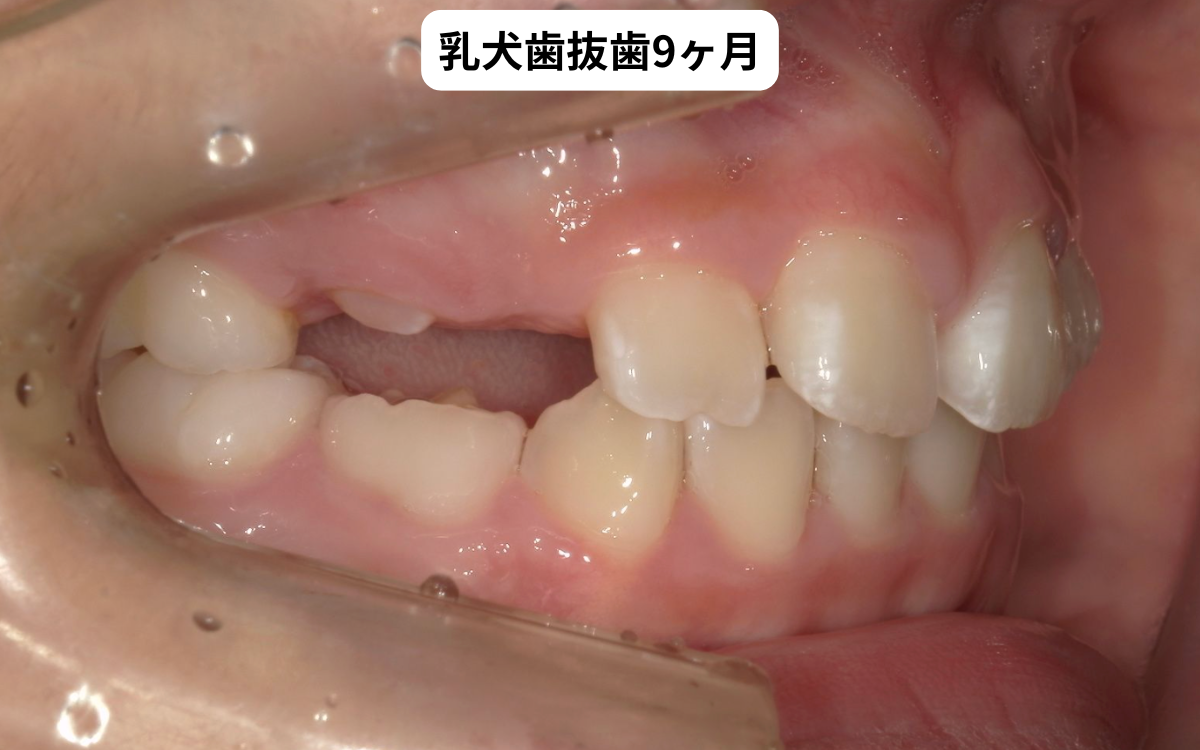 乳犬歯抜歯9ヶ月後の経過写真｜犬歯はまだ萌出していない｜奈良の矯正歯科 氏井矯正歯科クリニック