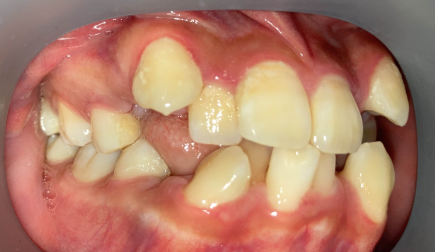 抜歯矯正2週間後の経過写真｜隙間閉鎖の経過｜奈良の矯正歯科
