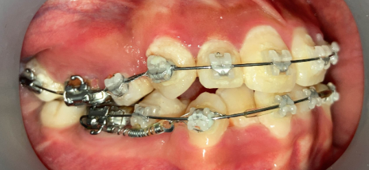 抜歯矯正2ヶ月後の経過写真｜隙間が縮小｜奈良の矯正歯科