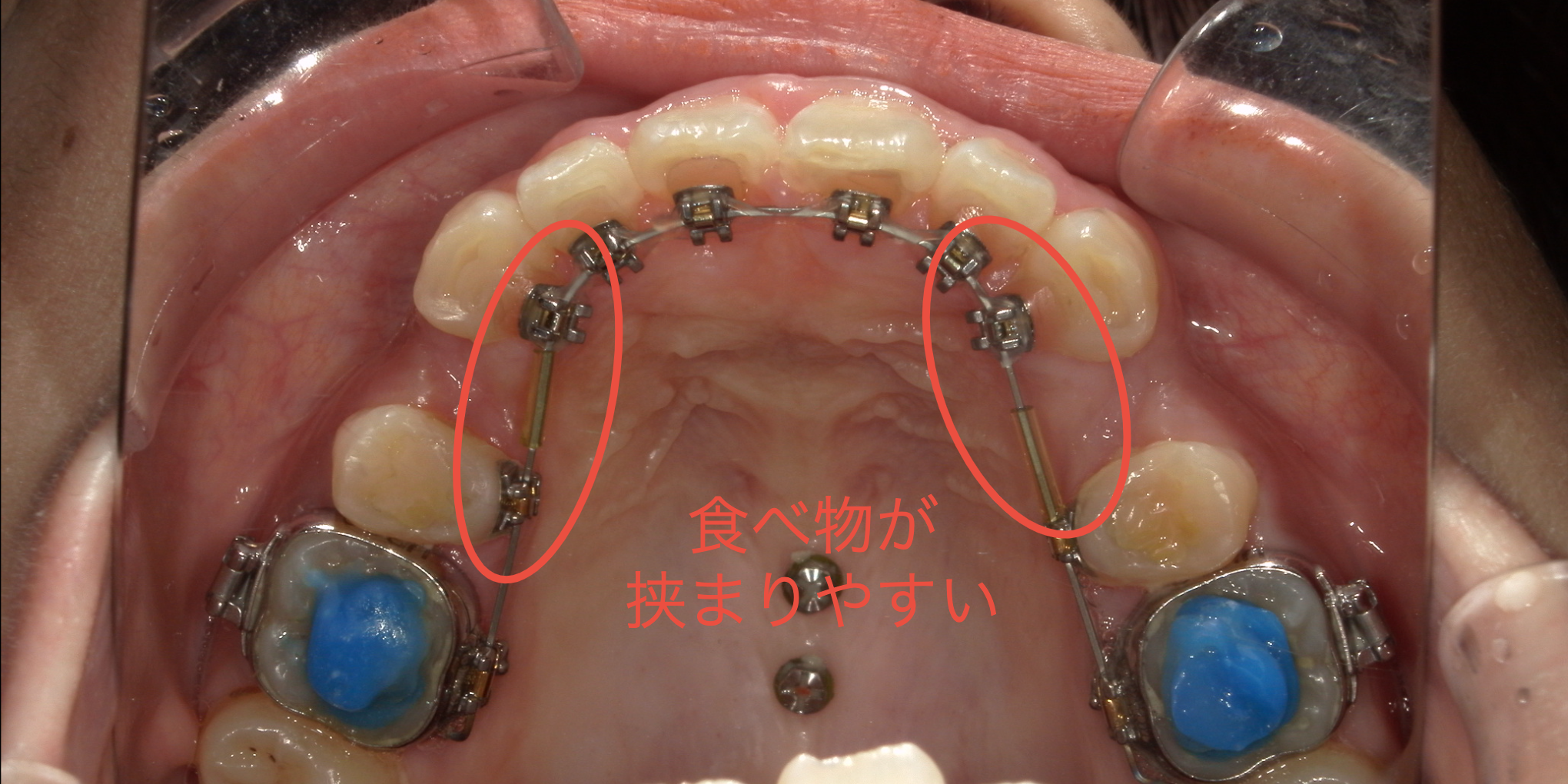リンガル矯正装置に食物繊維が絡まった状態の写真｜奈良の矯正歯科