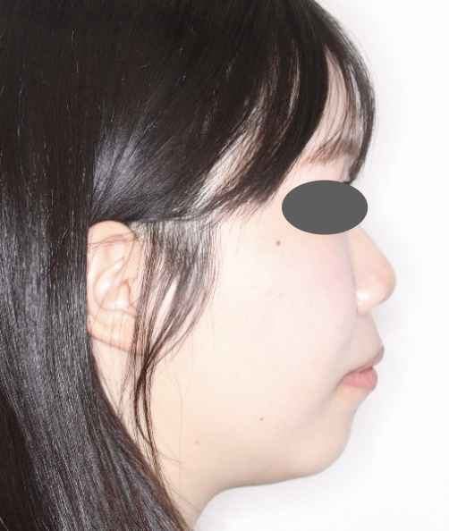 抜歯矯正完了後｜口元改善｜奈良の矯正歯科