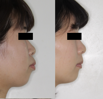 歯だけが原因の口ゴボ 治療イメージ