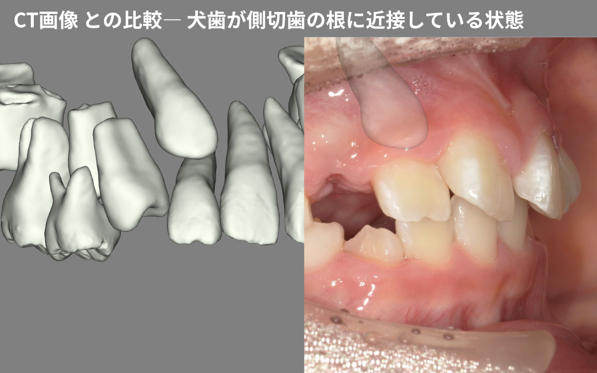 埋伏犬歯のCT 3D画像と口腔内写真の比較｜奈良の矯正歯科 氏井矯正歯科クリニック