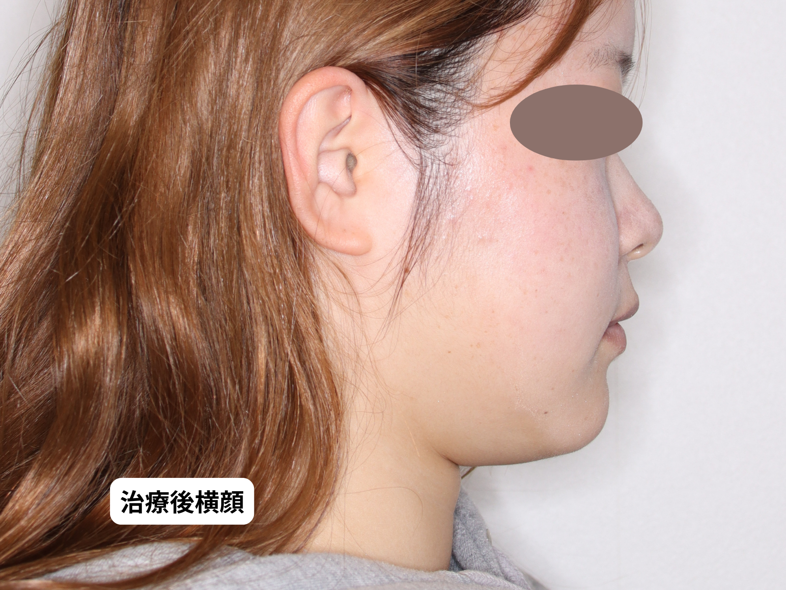 出っ歯・口ゴボ 矯正治療後 横顔｜奈良の矯正歯科 氏井矯正歯科クリニック