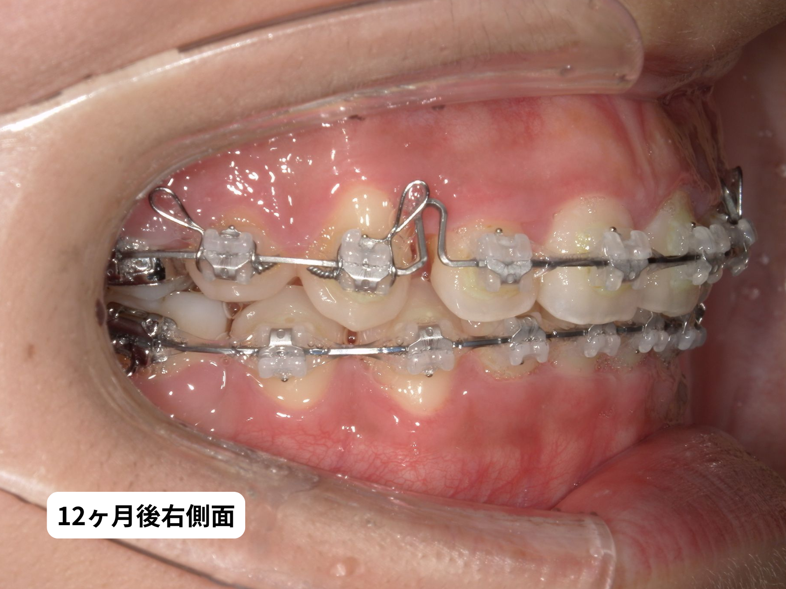 先天性欠如歯 矯正治療 12ヶ月後 右側面｜奈良の矯正歯科 氏井矯正歯科クリニック