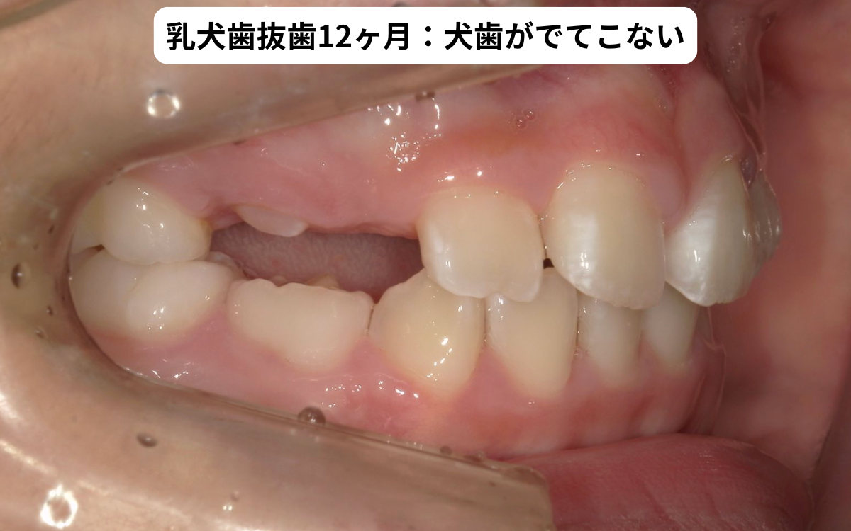 乳犬歯抜歯12ヶ月後｜犬歯が出てこないため開窓牽引を検討｜奈良の矯正歯科 氏井矯正歯科クリニック