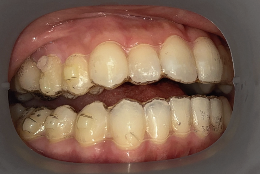 矯正治療中の口腔内写真