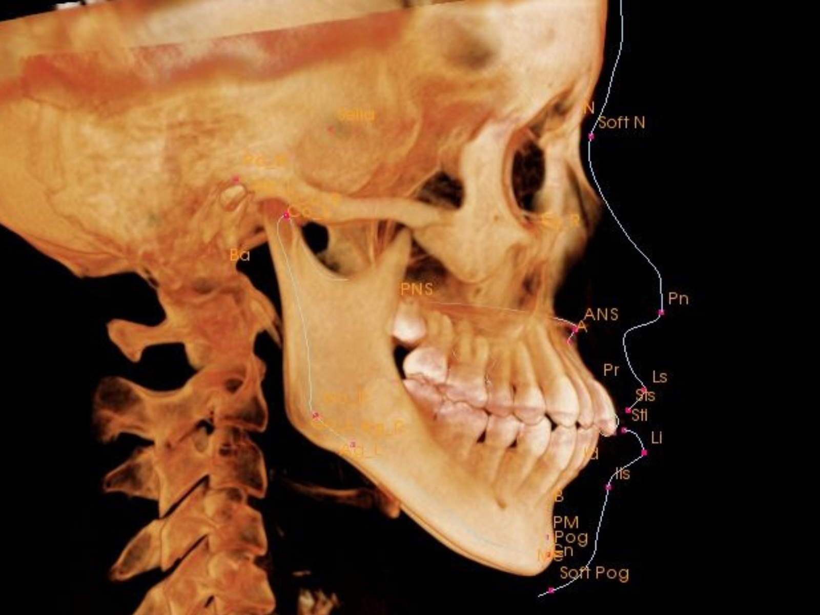 矯正治療前の横顔｜奈良の矯正歯科 氏井矯正歯科クリニック