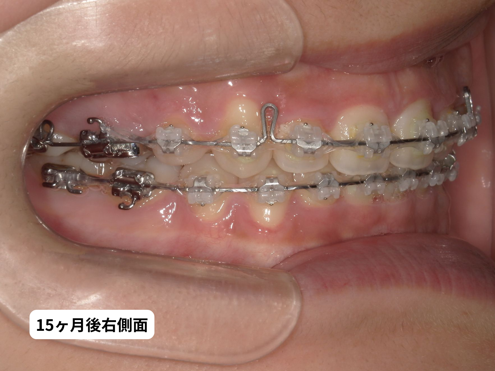 先天性欠如歯 矯正治療 15ヶ月後 右側面｜奈良の矯正歯科 氏井矯正歯科クリニック