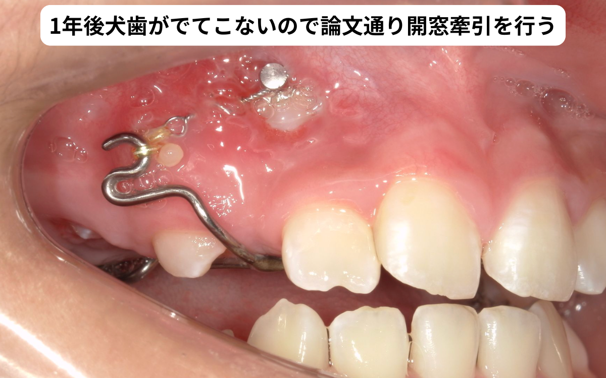 埋伏犬歯の開窓牽引中の口腔内写真｜奈良の矯正歯科 氏井矯正歯科クリニック