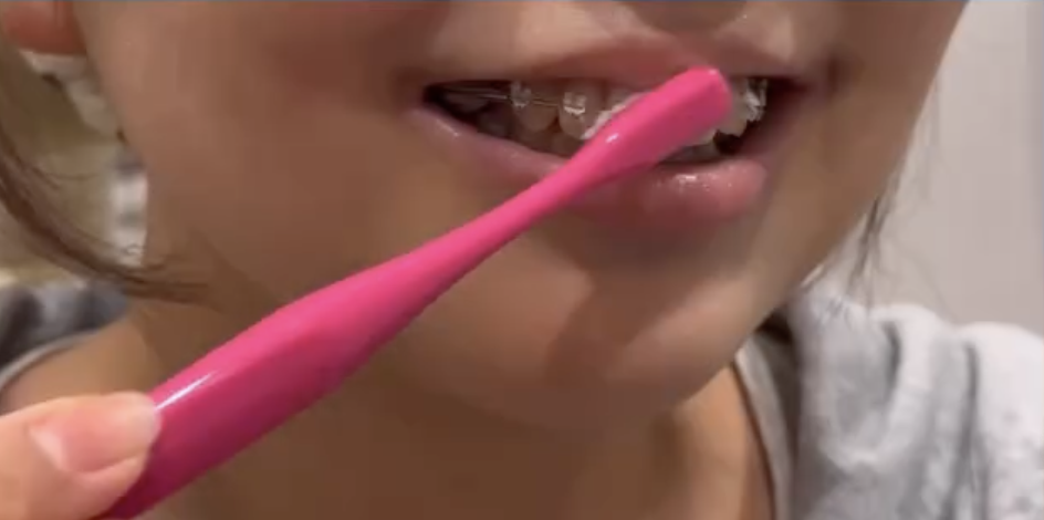 タフトブラシで矯正装置周りを磨いている写真｜奈良の矯正歯科