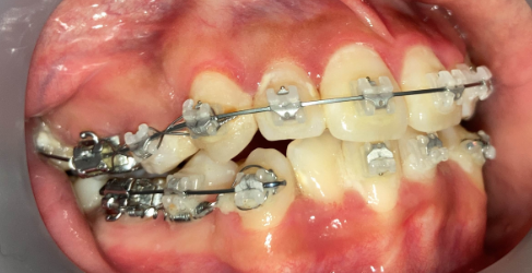 抜歯矯正3ヶ月後の経過写真｜隙間が半分に｜奈良の矯正歯科