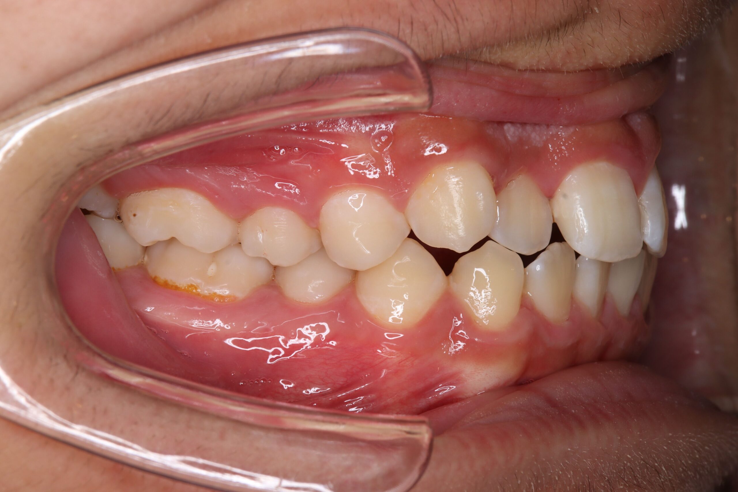 非抜歯アンカー矯正の初診時｜奈良の矯正歯科