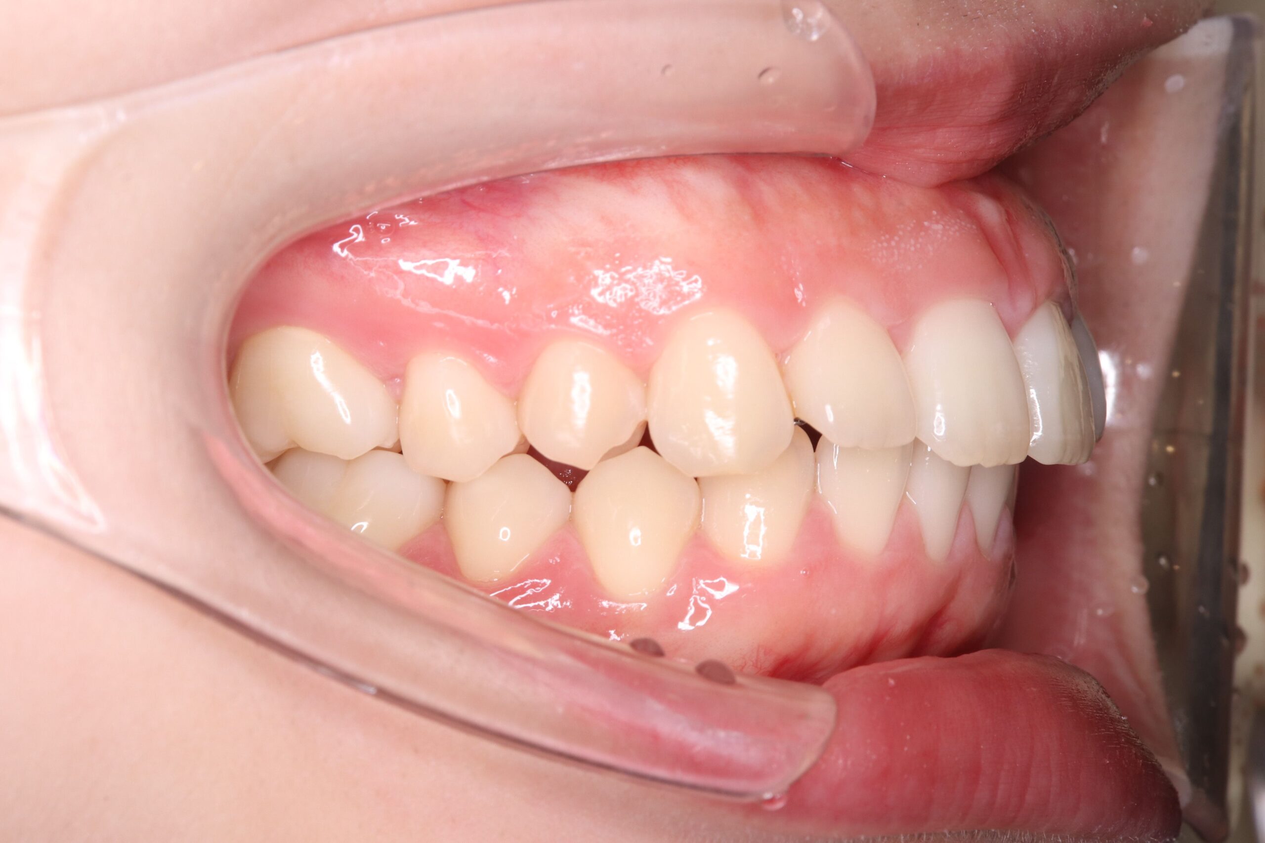 リカバリー症例の初診時の口腔内｜奈良の矯正歯科