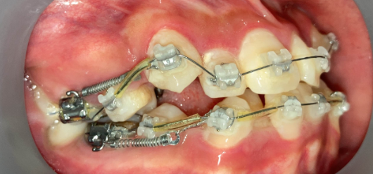 抜歯矯正3週間後の経過写真｜隙間閉鎖の経過｜奈良の矯正歯科