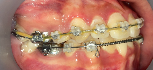 抜歯矯正の隙間ほぼ閉鎖完了写真｜約6ヶ月後｜奈良の矯正歯科