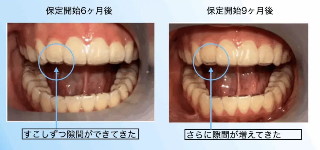 保定をさぼった場合の後戻り経過（保定開始6ヶ月後・9ヶ月後の比較）｜奈良の矯正歯科