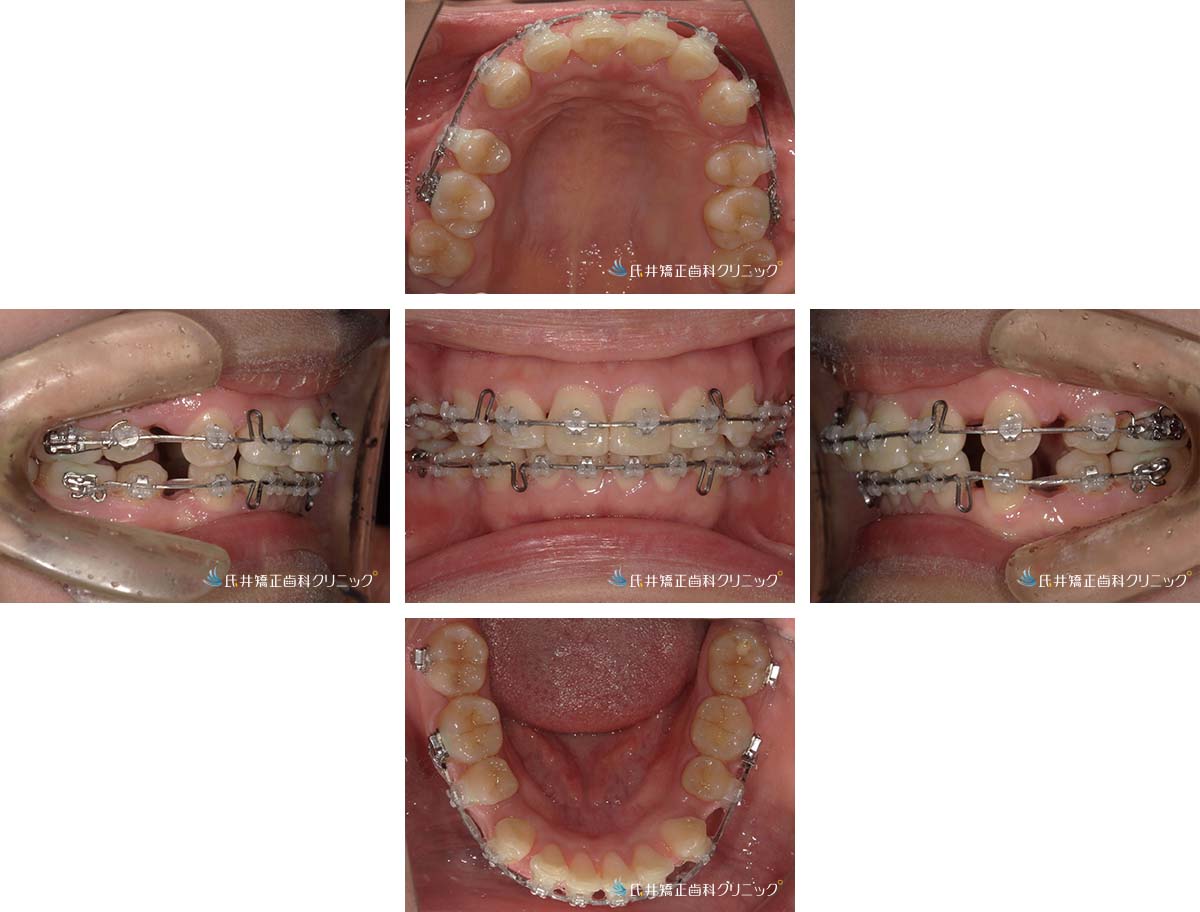 治療中（6ヶ月後）