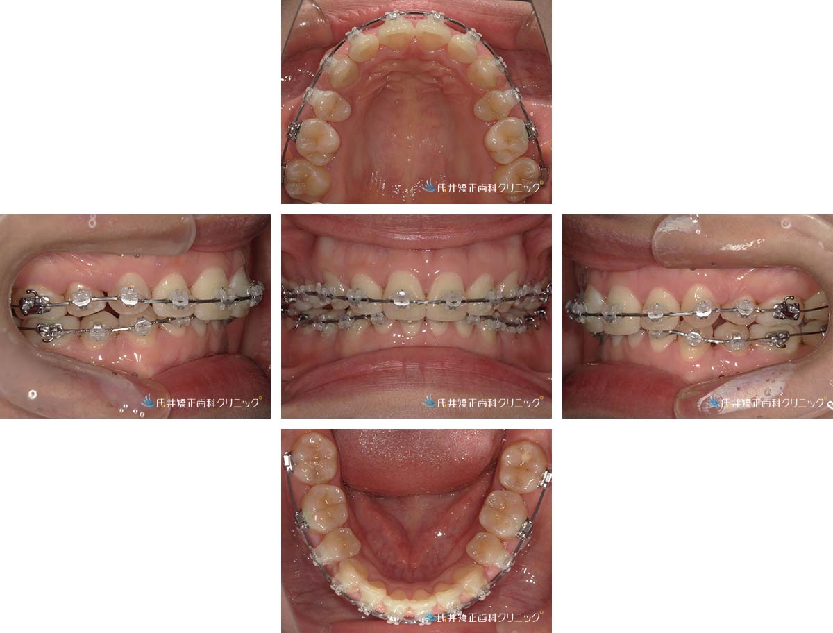 治療中（12ヶ月後）