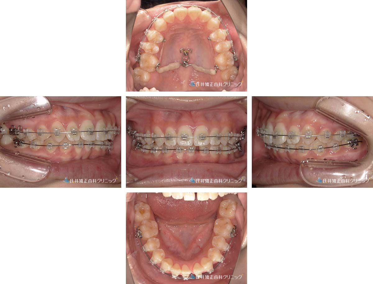 治療中（5ヶ月後）