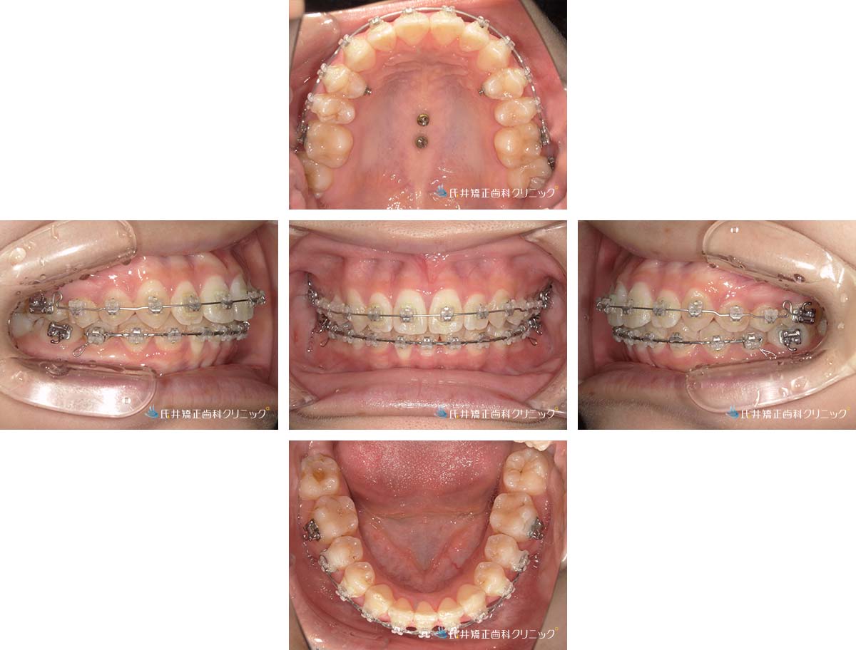 治療中（20ヶ月後）