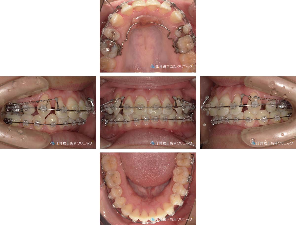 治療中（6ヶ月後）