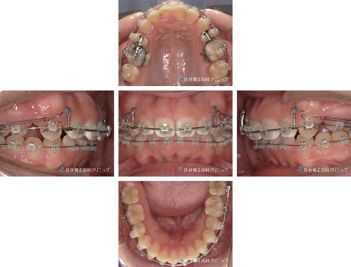 治療中（12ヶ月後）