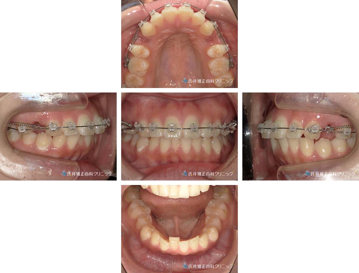 治療中（5ヶ月後）
