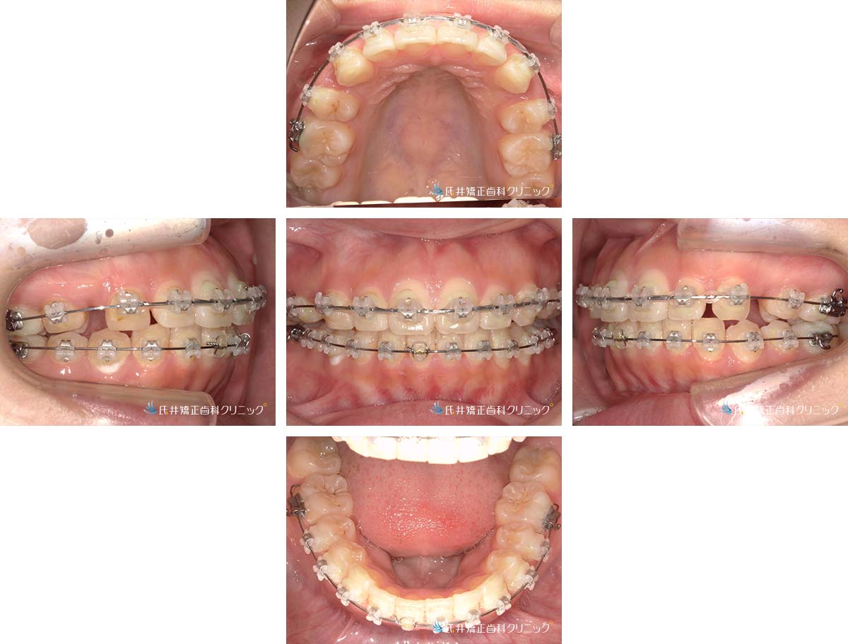 治療中（10ヶ月後）