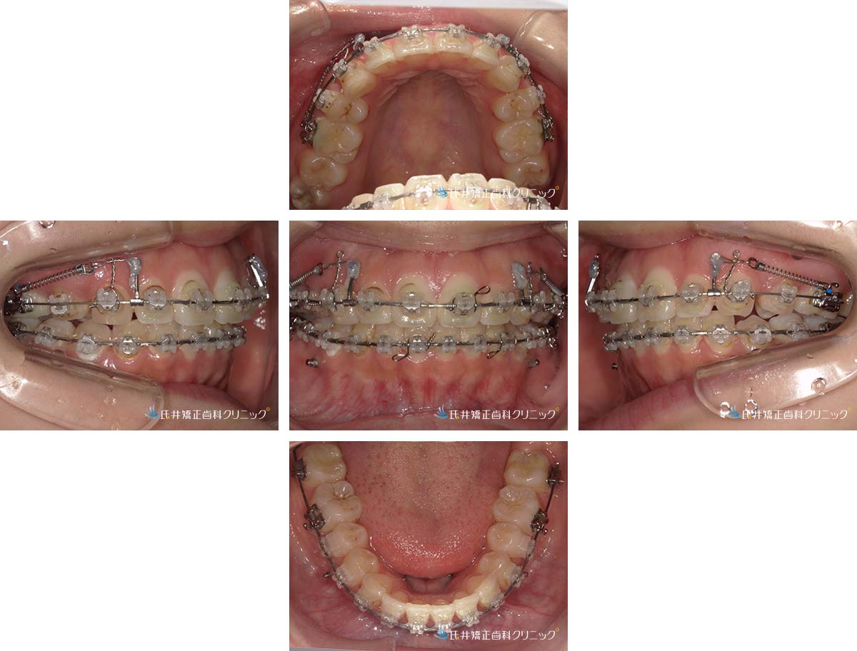 治療中（17ヶ月後）