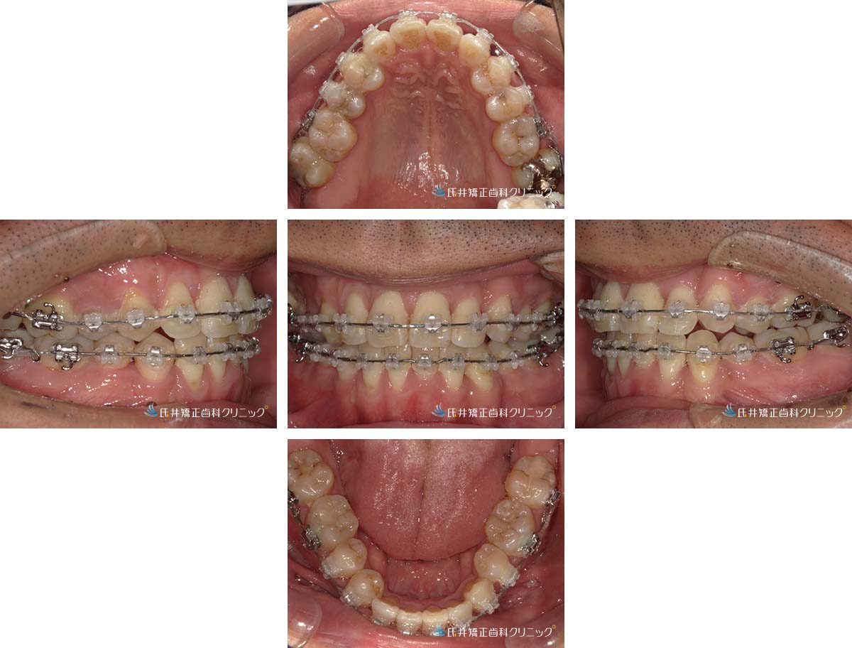 治療中（18ヶ月後）