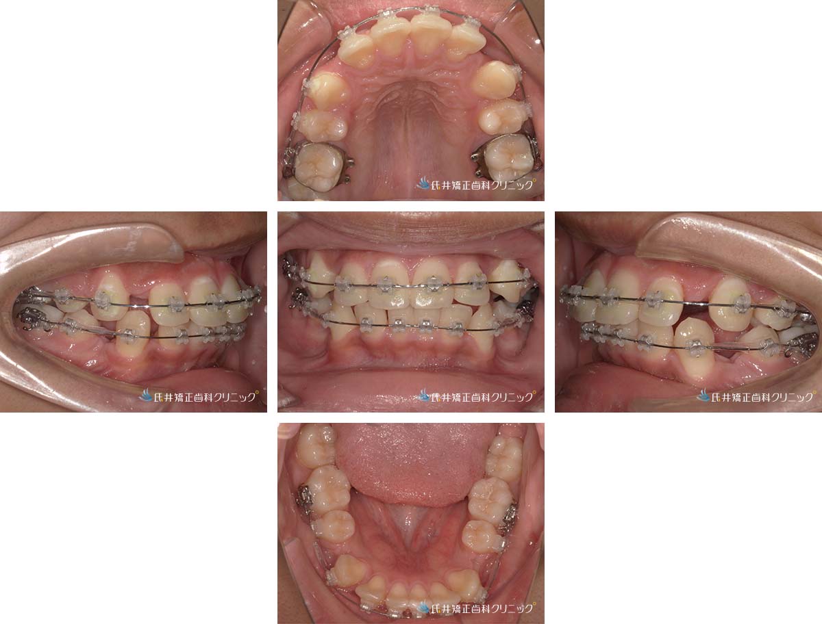 治療中（6ヶ月後）
