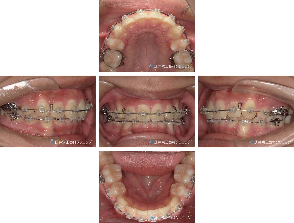 治療中（18ヶ月後）