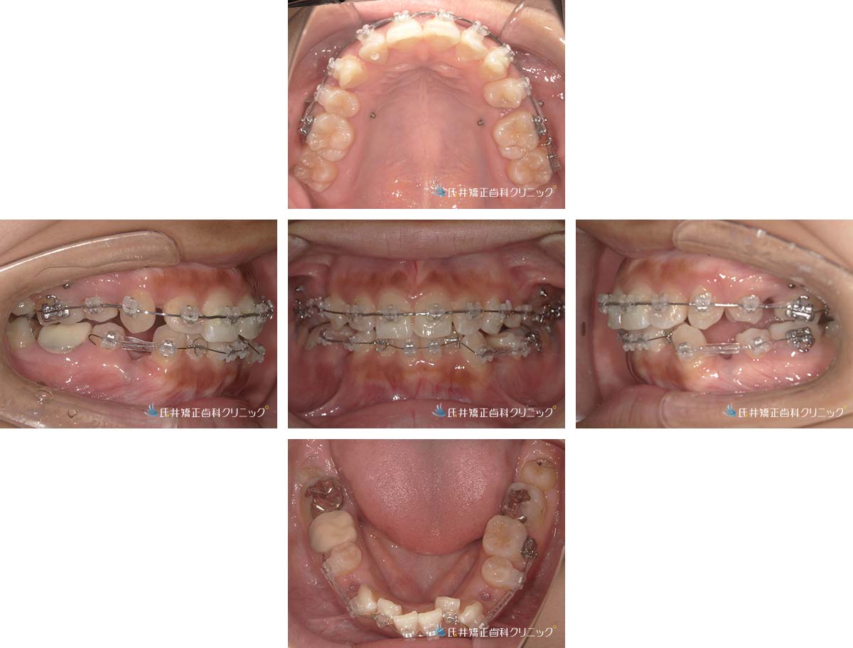 治療中（5ヶ月後）