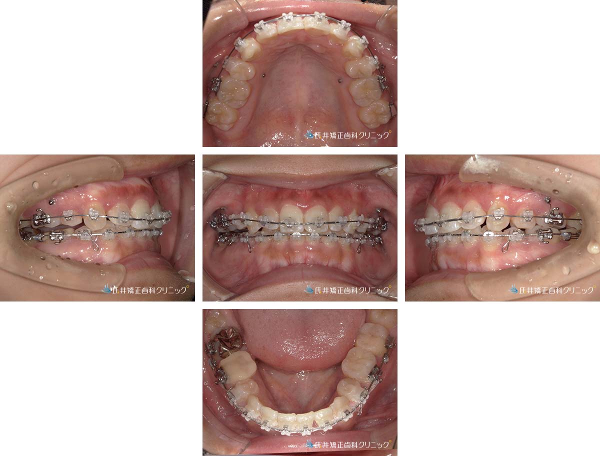 治療中（20ヶ月後）