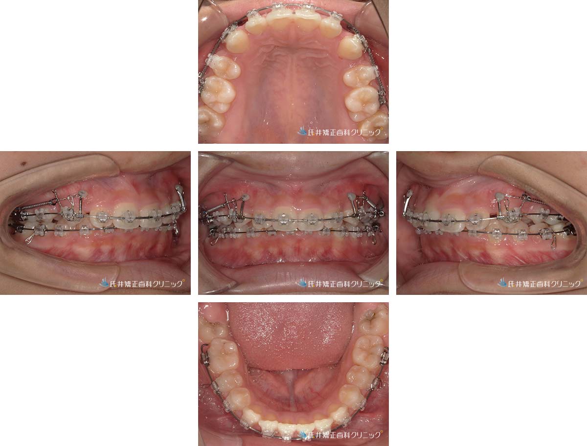 治療中（6ヶ月後）