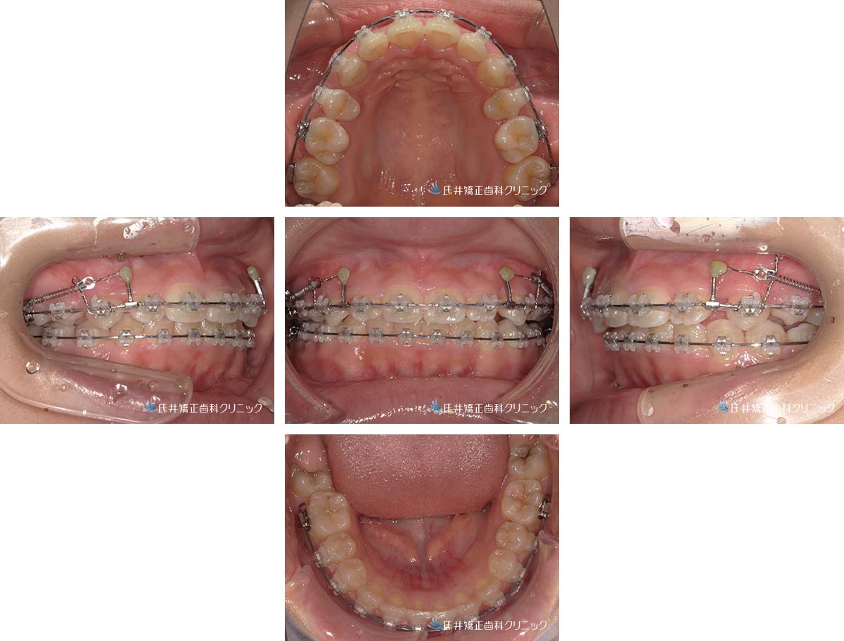 治療中（12ヶ月後）