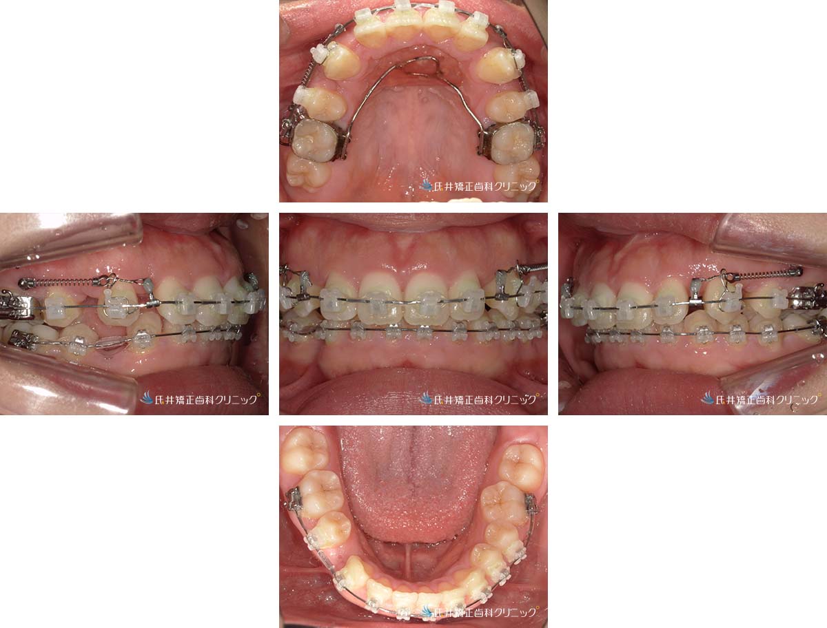 治療中（6ヶ月後）