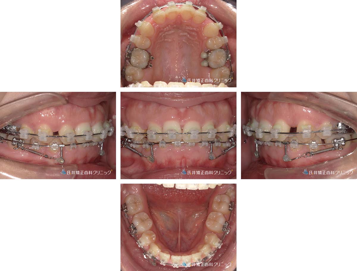 治療中（18ヶ月後）