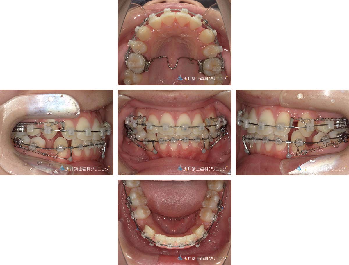 治療中（6ヶ月後）