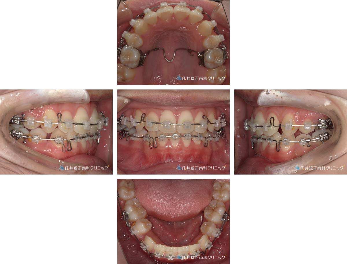 治療中（1年後）