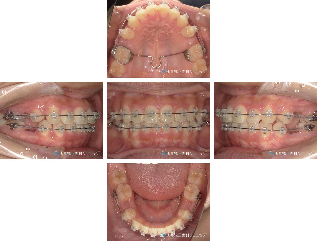 治療中（3ヶ月後）