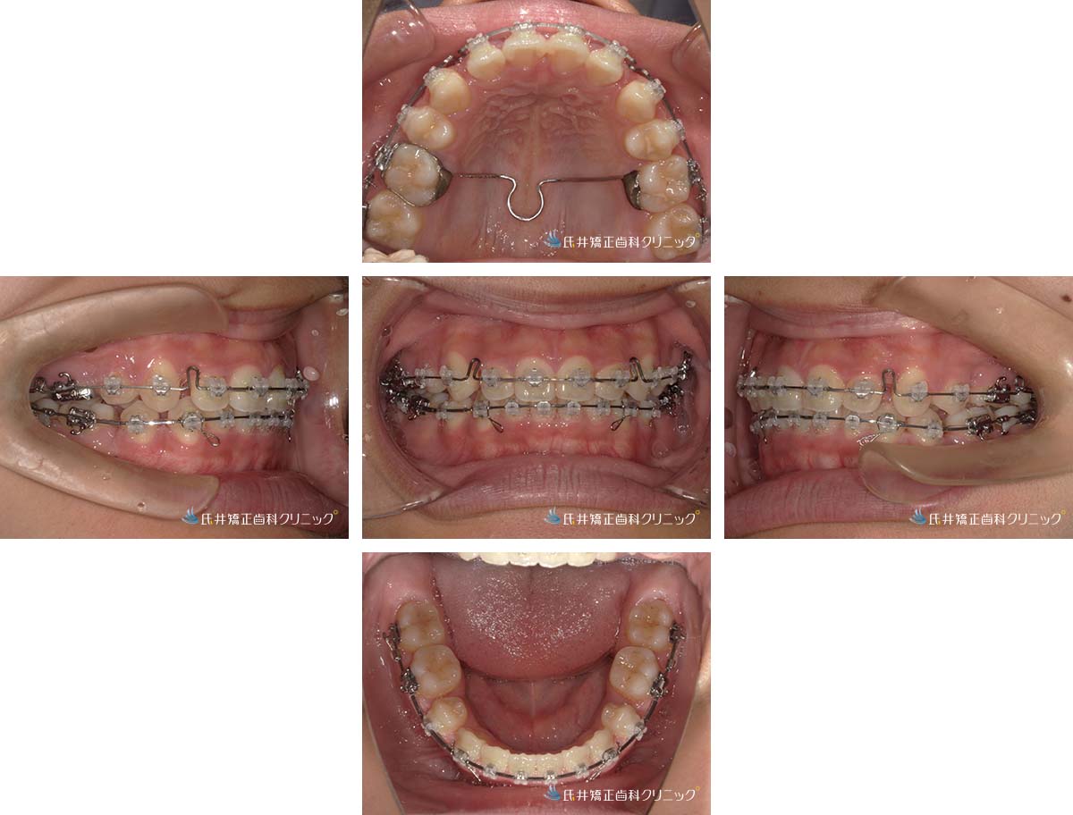 治療中（1年後）